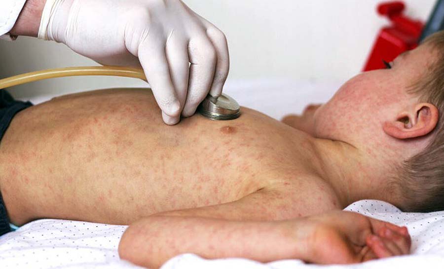 Sarampo: com 30% de cobertura vacinal, país tem risco de surtos