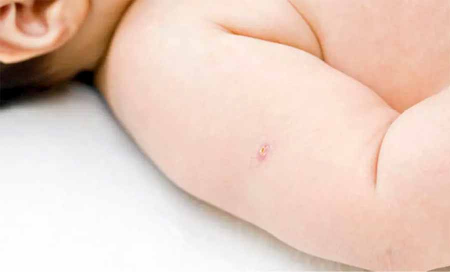 Mais de 75% dos bebês receberam a vacina BCG em seis meses no Acre