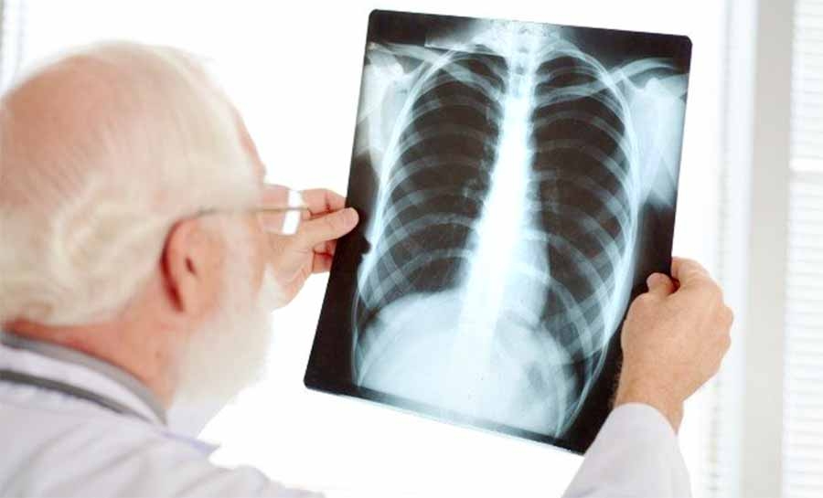 Pneumonia silenciosa: o perigo por trás da doença “escondida”