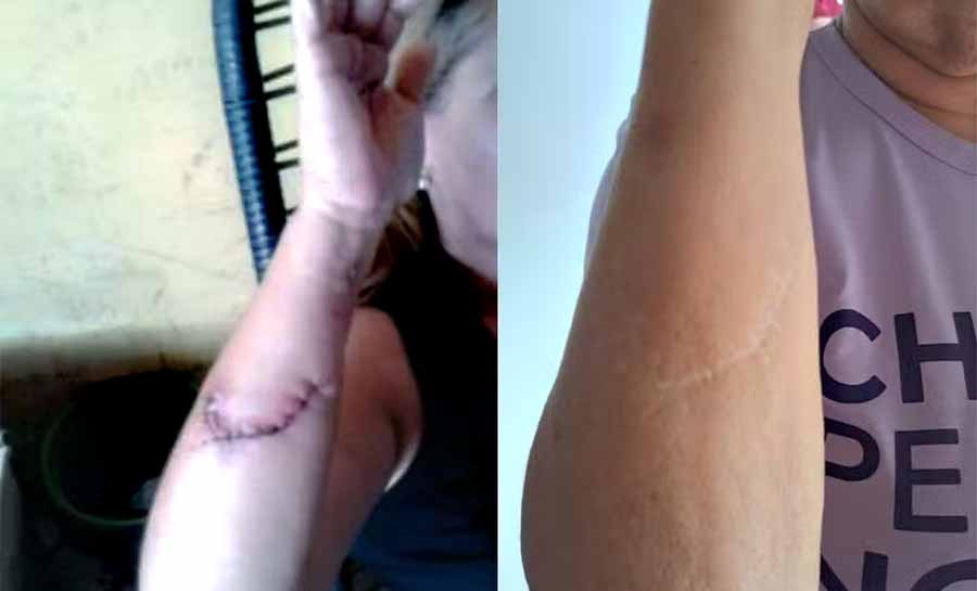 Mulher que caiu em fossa após procurar necrotério de hospital do AC é indenizada em R$ 14 mil: ‘Pensei que ia morrer no esgoto’