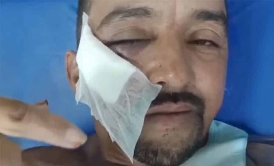 Gari é atingido com tijolada no rosto ao se recusar recolher garrafa no Acre: ‘Quebrou um osso’